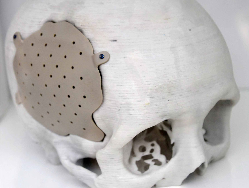 這張“白色的膏藥”的真面目就是生物3D打印的腦膜。
